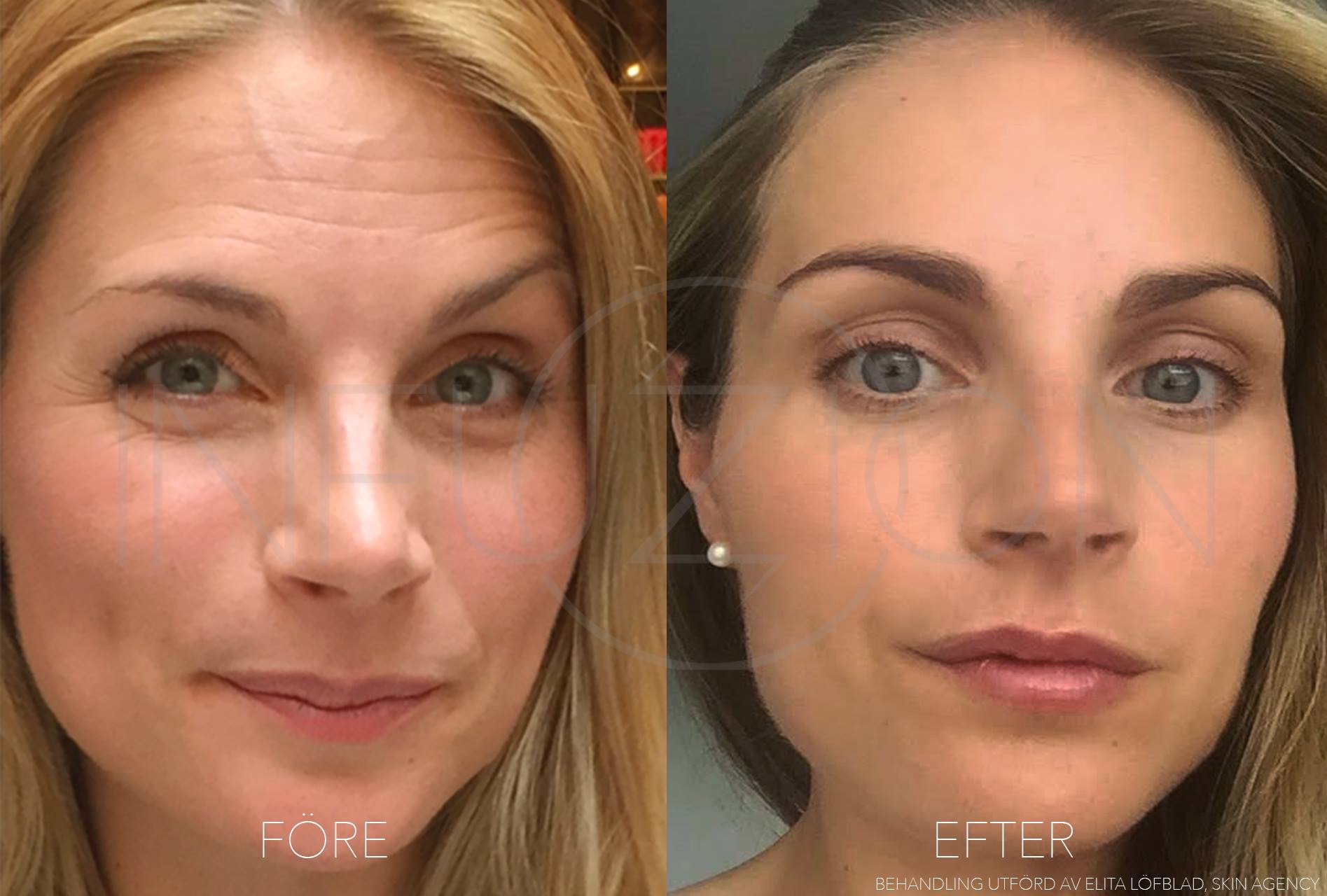 Infuzion Hyaluron Filler Medical Spa Passau Astrid Schwamberger